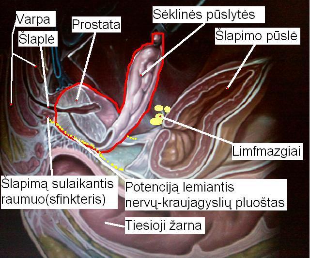 Prostatos vėžio operacijos schema
